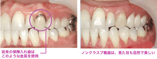 従来の入れ歯とノンクラスプ義歯の比較